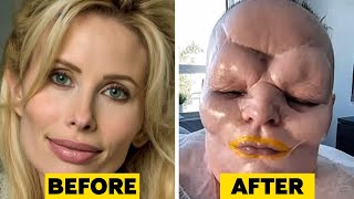 15 Times Plastic Surgery Went Horribly Wrong [upl. by Haiasi678]