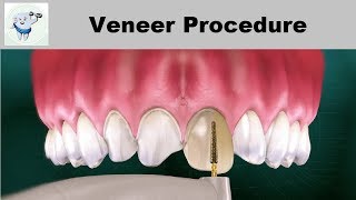 Dental Veneers Procedure Step by step [upl. by Nnaxor]