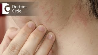 What are the common skin allergies  Dr Sachith Abraham [upl. by Oap642]