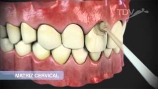 MATRIZ CERVICAL TDV  Restauraciones de Clase V [upl. by Tnelc500]