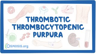 Thrombotic thrombocytopenic purpura NORD [upl. by Atena]