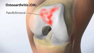 MAKOplasty Partial Knee Resurfacing [upl. by Bowles]