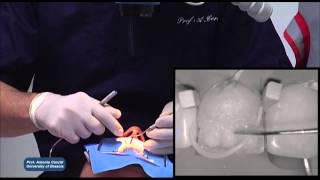 IPS Empress Direct StepbyStep with Prof Antonio Cerutti [upl. by Latrena452]