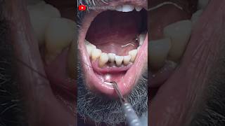 Extraction of Decayed Front Aesthetic Teeth toothextraction rootcanaltreatment dentistry [upl. by Yttel]