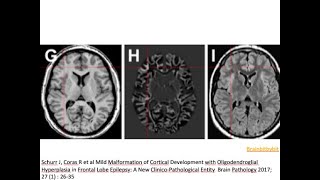 38 MOGHE mild malformation oligodendroglial hyperplasia ILAE classification 2022 epilepsy [upl. by Llenrup]