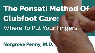 The Ponseti Method Of Clubfoot Care׃ Where To Put Your Fingers [upl. by Prebo]