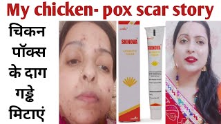 चिकन पॉक्स या चेचक का दाग कैसे हटाये  Chikan pox ke daag aur gadde ilaj  Chikan pox scras [upl. by Eitra]