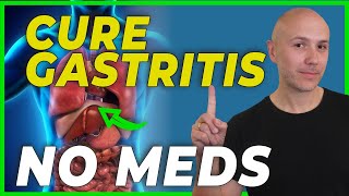 HOW to CURE GASTRITIS without medications  DR CARLOS [upl. by Girardi851]