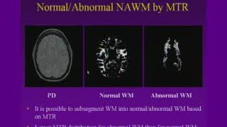 White Matter Disease CT and MRI [upl. by Atimad]