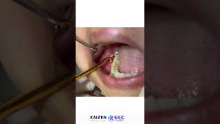 Impacted Wisdom Tooth Removal Odontectomy [upl. by Orel226]