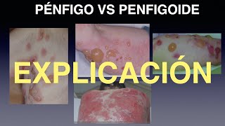 PeÌnfigo vs Penfigoide Comparativa [upl. by Enirehs]