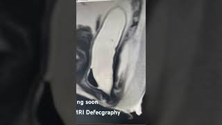 MRI Defecography mri [upl. by Yremogtnom733]