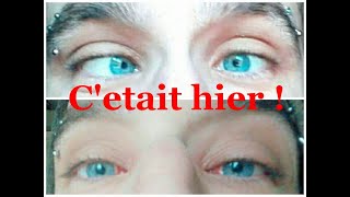 Lendemain doperation du strabismeTOUT VA BIEN strabismus operation [upl. by Asital]