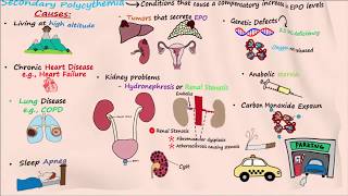 Polycythemia  Part 2 [upl. by Perzan]