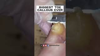 SHAVING OF REAL BIG TOE CALLUS 🦶 BIGGEST TOE CALLOUS EVER FULL TREATMENT BY MISS FOOT FIXER [upl. by Ahsima]