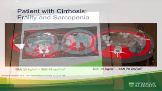 Congreso Internacional  El Enfermo con Cirrosis Fragilidad y Sarcopenia por Dr Aldo Montaño [upl. by Maguire]