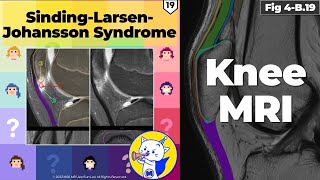 Fig 4B19 SindingLarsenJohansson Syndrome [upl. by Assirac]