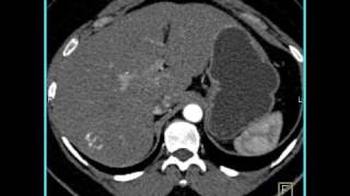 Abdomen Liver Hemangioma of the Liver1 of 8 [upl. by Slosberg]