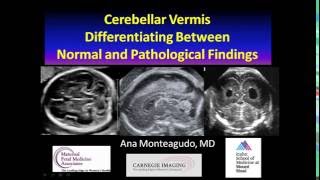 AIUM Webinar Cerebellar Vermis [upl. by Massimiliano289]