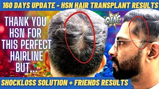 HSN Hair Transplant Results  160 Days Update hsnbangalore hairtransplantintamil ameerht [upl. by Aubin]