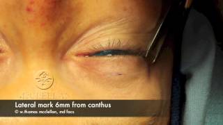 Live Surgery Upper Blepharoplasty Eyelid Lift Part 1 Markings and Anesthesia [upl. by Nosak198]