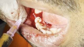 Explosive Dental abscess drainage and tooth extraction  Live On Patient [upl. by Ahsatal]