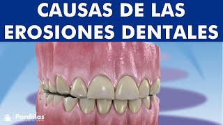 Abfracción atrición abrasión reabsorción dental y otros problemas de desgaste de los dientes © [upl. by Ynotna]