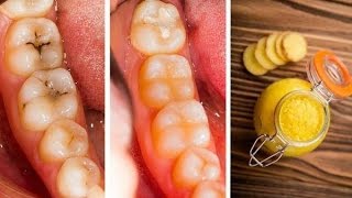 Remedies To Cure Cavities In 1 Day [upl. by Papageno]