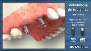 Reposición de varios dientes mediante dos implantes [upl. by Clayborn757]