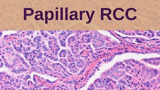 Papillary Renal Cell Carcinoma  Pathology mini tutorial [upl. by Kostman439]