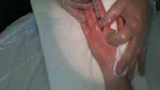 Palmar Hyperhidrosis Botox Procedure [upl. by Aitercal228]