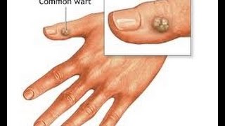 How to get rid of warts on neck fingers and hands [upl. by Aronael448]