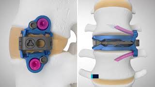 ELSA™ Expandable Integrated Lateral Lumbar Interbody Technique Animation [upl. by Ydnem]