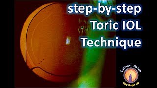 StepbyStep Technique for Toric IOLs  Beautifully performed cataract surgery [upl. by Acquah]