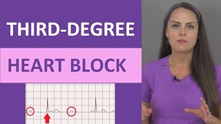 ThirdDegree AV Heart Block ECG Nursing Rhythm NCLEX  Complete Heart Block [upl. by Rehpotsirk]