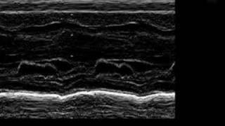 Asymmetric Septal Hypertrophy ASH in an Infant [upl. by Holloway]