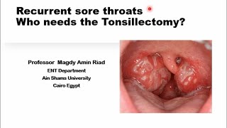 Recurrent sore throats Who needs the Tonsillectomy [upl. by Helman919]