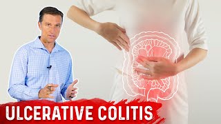 What is Ulcerative Colitis – Causes Symptoms amp Treatment by DrBerg [upl. by Lavelle63]