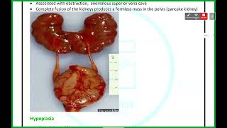 UGS Pathology  Anomalies amp Cystic Kidney Diseases  Mutah [upl. by Umeko]