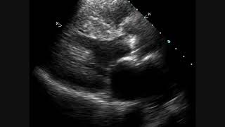 Calcific Aortic Stenosis  Echocardiogram [upl. by Marlen230]