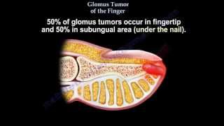 Glomus Tumor Of The Finger  Everything You Need To Know  Dr Nabil Ebraheim [upl. by Saree622]