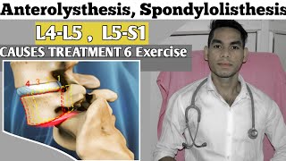 Anterolisthesis spondylolisthesis L5s1 spondylolisthesis Treatment Exercise Low back pain [upl. by Ayrb]