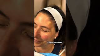 AUTOCORRE  RESTORING amp REJUVENATING YOUR SKIN NATURALLY [upl. by Eicnan999]