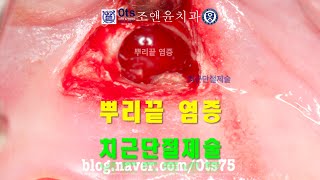 치아를 살리는 치근단절제술 Apicosurgery for tooth preservation [upl. by Suoiluj853]