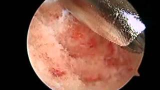 Posterior Arthroscopy with Haglunds Deformity Debridement SFISM [upl. by Derrej60]