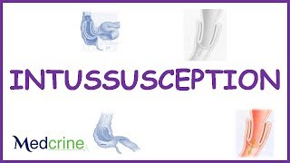 Intussusception  causes types  pathophysiologyfeaturesdx and treatment [upl. by Row]