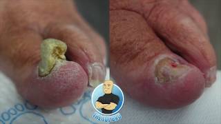 TRIMMING A quotTHICCquot TOENAIL  AMAZING BEFORE AND AFTER [upl. by Adok]