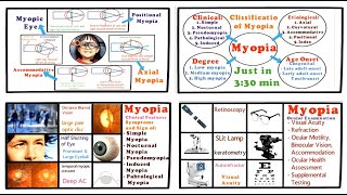 Myopia  Full Tutorial Introduction Classification Clinical Features and Management [upl. by Ikceb]