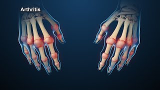 Rheumatoid Arthritis Animation [upl. by Nesila]