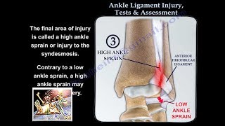 Ankle Ligament Injury evaluation and tests  Everything You Need To Know  Dr Nabil Ebraheim [upl. by Yrogiarc]